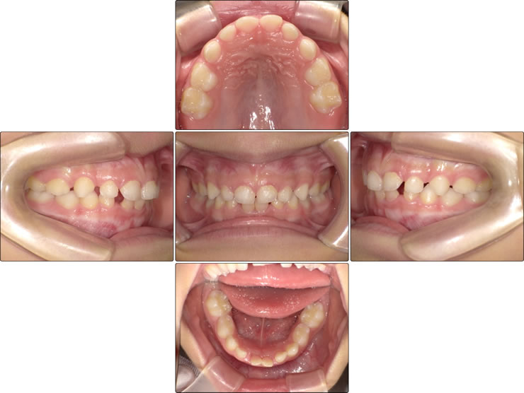 過蓋咬合にはどのような種類の矯正装置が最適ですか?