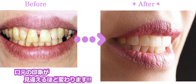 歯を削らずに白い歯に